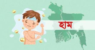 হামের উপসর্গে আরো ২ শিশুর মৃত্যু